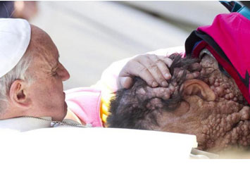 Pope Francis Blessing a Disfigured man 